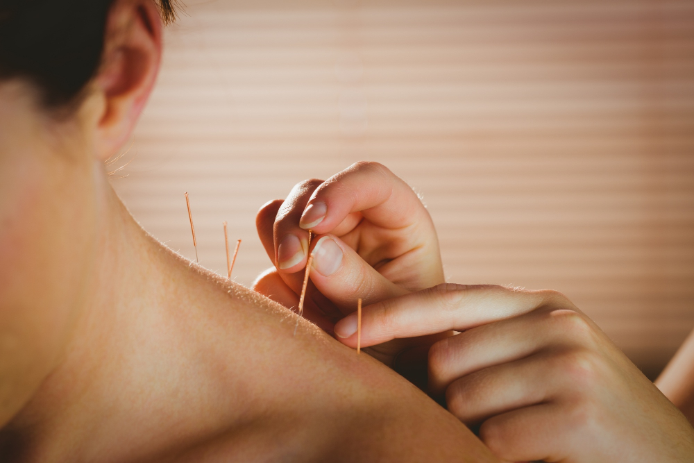 Ancient Wisdom, Modern Solutions The Role of Acupuncture in Healthcare Today