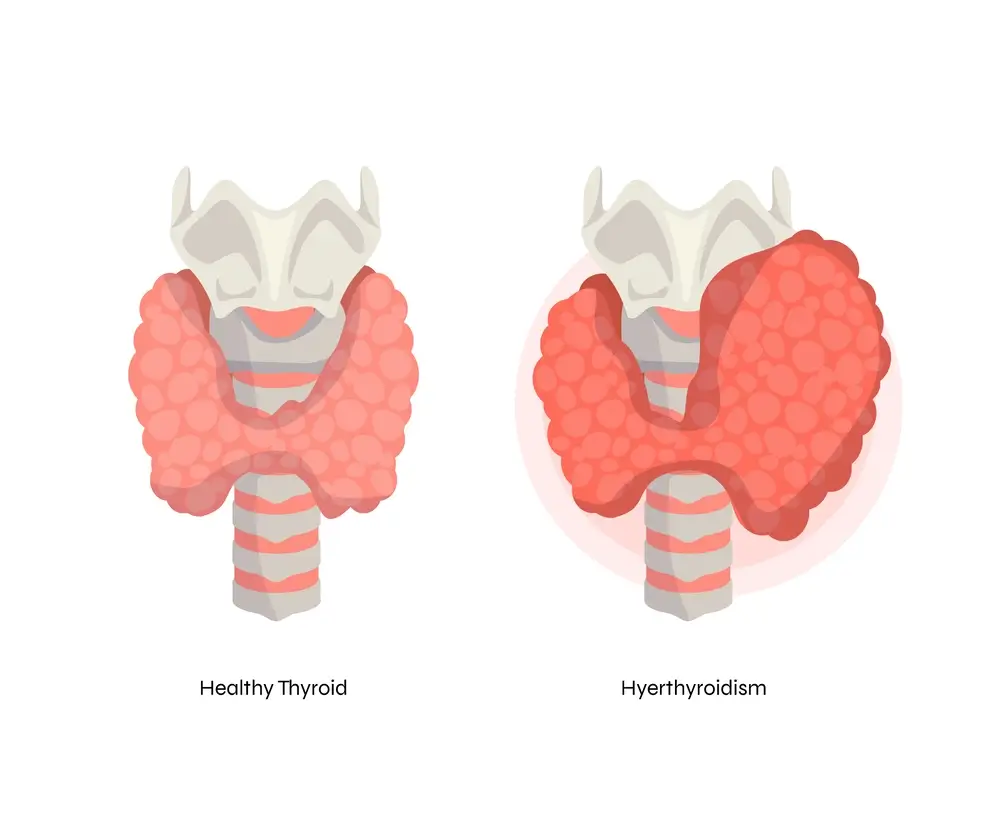 Stay Ahead of Thyroid Cancer: Key Tips to Protect Your Thyroid